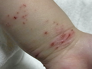 湿疹その後の記録 子どもの喘息 アレルギー